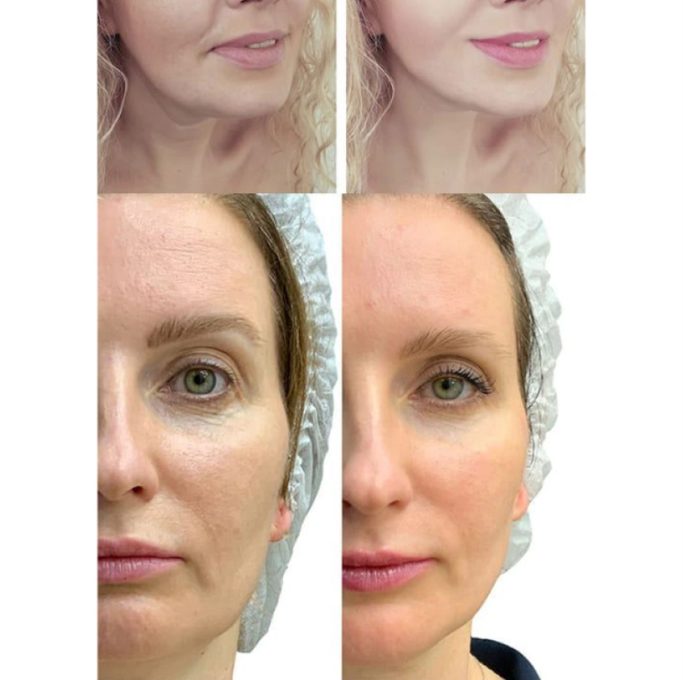 Микротоковый RF Lifting Массажер для лица Skin Lifting 7.0 Pink - EMS, LED Medica+/5